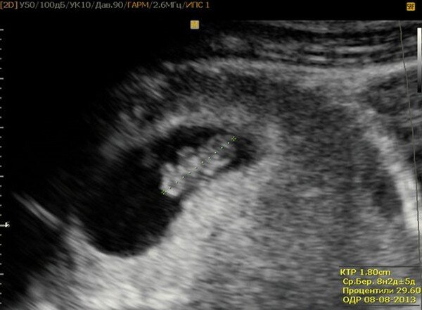 Роды на 8 неделе. 8 Недель беременности фото плода на УЗИ. Плод на 8 неделе беременности УЗИ. Беременность 7-8 недель фото эмбриона на УЗИ. УЗИ беременной 8 недель.