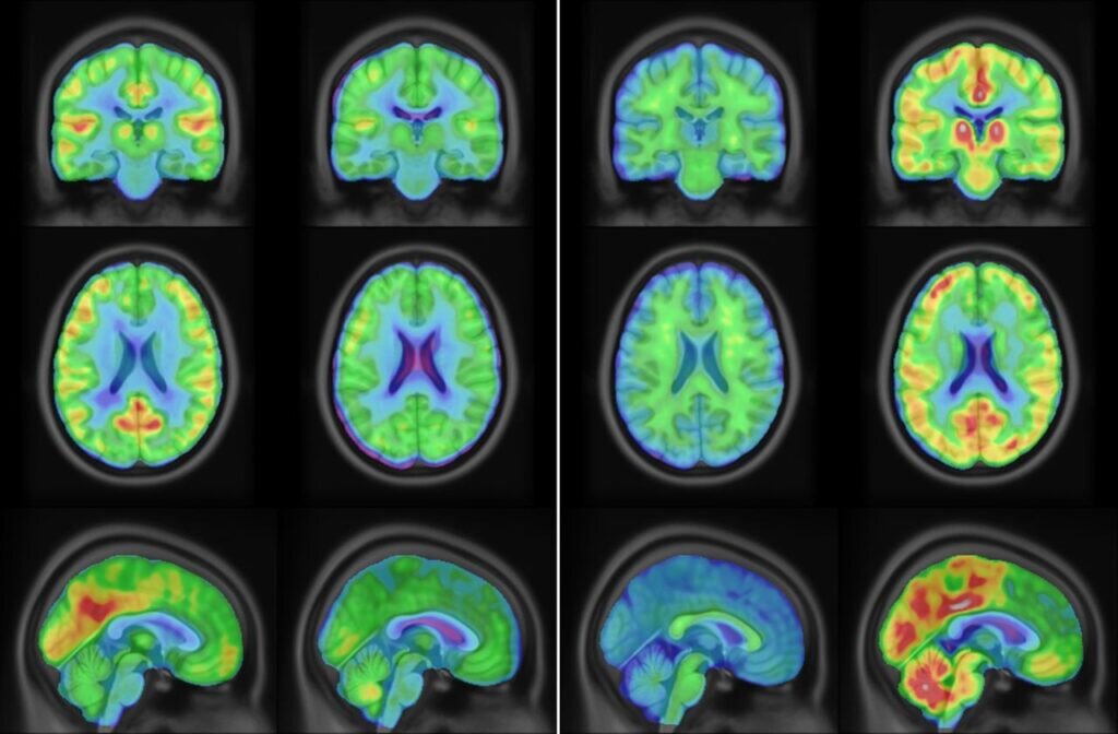    Изображения, полученные с помощью ПЭТ / © Shelley N. Acuff. et al.