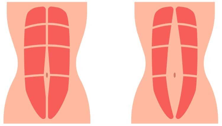 Слева нормальные прямые мышцы живота, справа - диастаз
