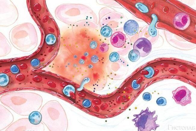 Очаг воспаления. Отёк ткани, иммунные клетки выходят из капилляров в очаге воспаления.