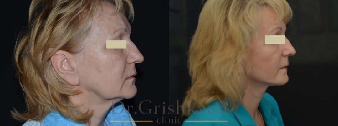 Фото до и после подтяжки лица. Фото с сайта Д.Р. Гришкяна. Имеются противопоказания, требуется консультация специалиста