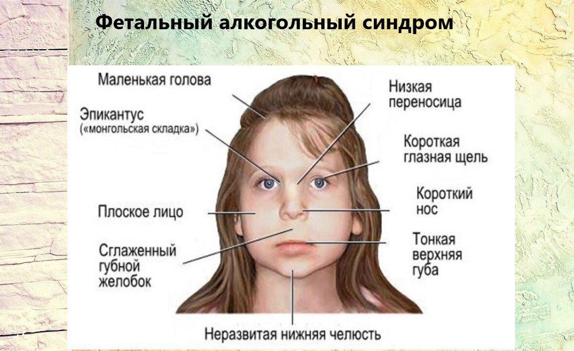 Алкогольный синдром