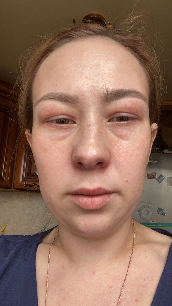 мои глаза в пик болезни