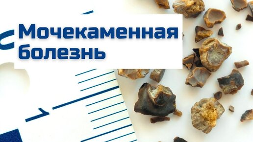 Мочекаменная болезнь - причины, симптомы, диагностика и лечение