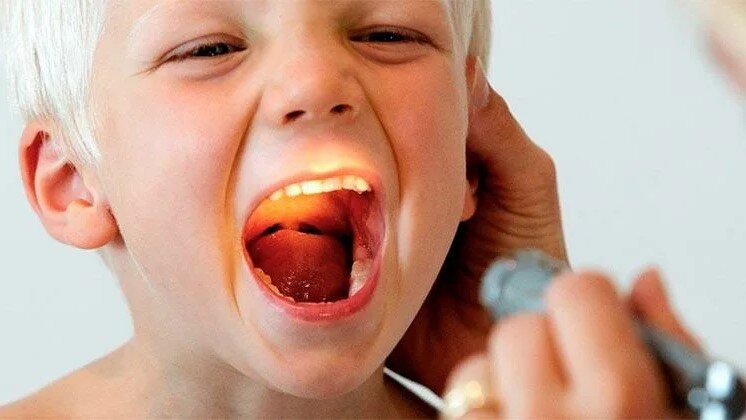 Фарингит: признаки, причины и лечение