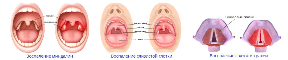 The 3 throats. Тонзиллиты фарингиты ларингиты. Тонзиллит фарингит ларингит ангина\. Тонзиллита (воспаление глоточной и нёбных миндалин). Дифтерия небных миндалин.