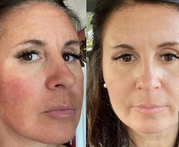 Как избавиться от акне: доступно о сути проблемы и почему очищение ...