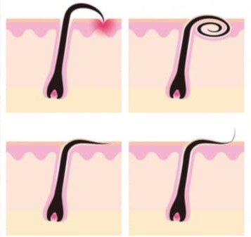 Типы вросших волос