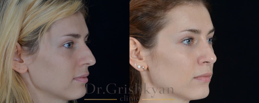 Закрытая ринопластика фото до и после. Фото с сайта Д.Р. Гришкяна. Имеются противопоказания, требуется консультация специалиста