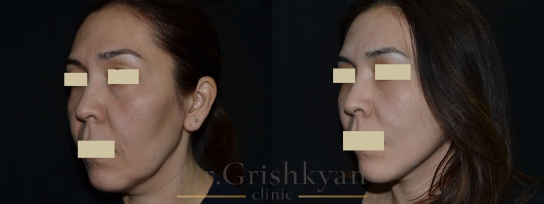 MACS-Lift с укороченным рубцом фото до и после. Фото с сайта Д.Р. Гришкяна. Имеются противопоказания, требуется консультация специалиста