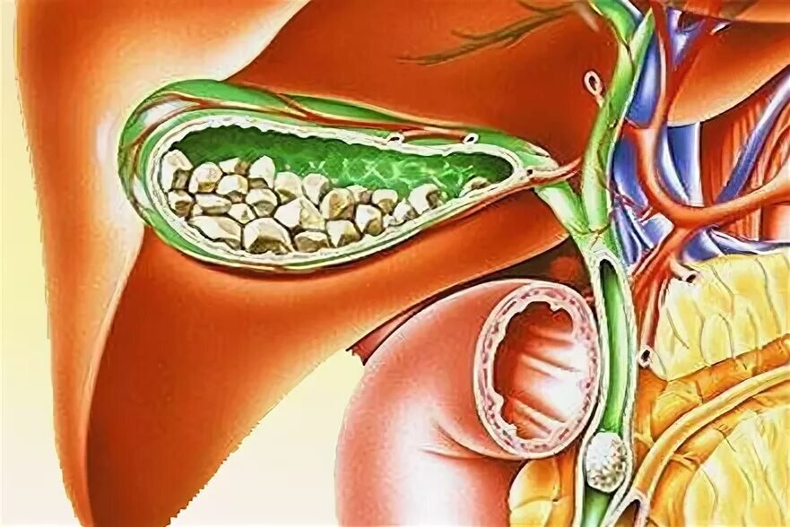 Желчь стоит — жди камней (
