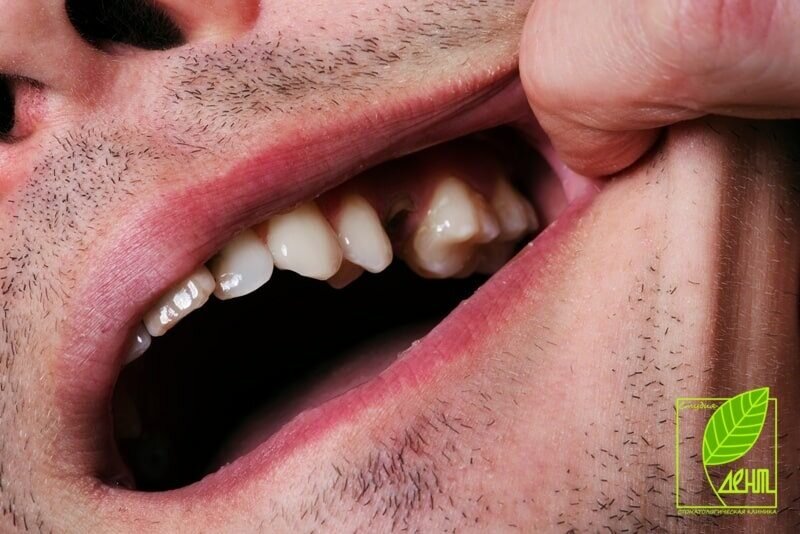 Как спасти шатающийся зуб от удаления – статьи стоматологической клиники «Доктор Мартин»