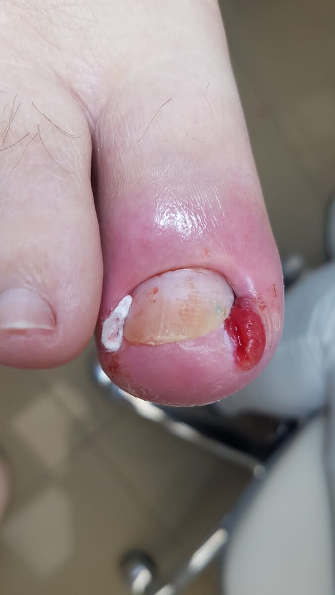 После обработки ВН подологом. 