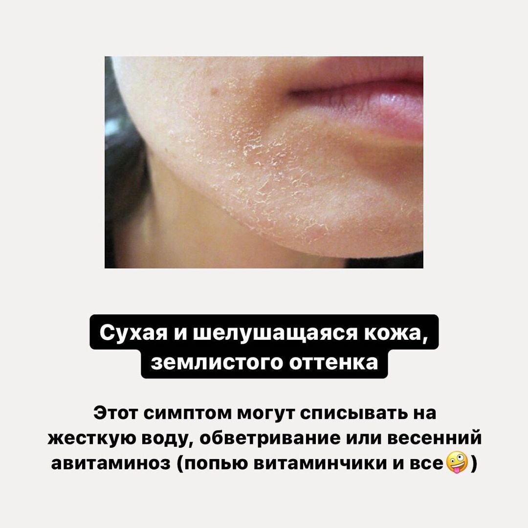 Синдром спазмофилии: симптомы хвостека, труссо, люста. Скрытая форма сахарного диабета. Примеры скрытых конфликтов. Маскированная депрессия психиатрия. Пример скрытого конфликта.