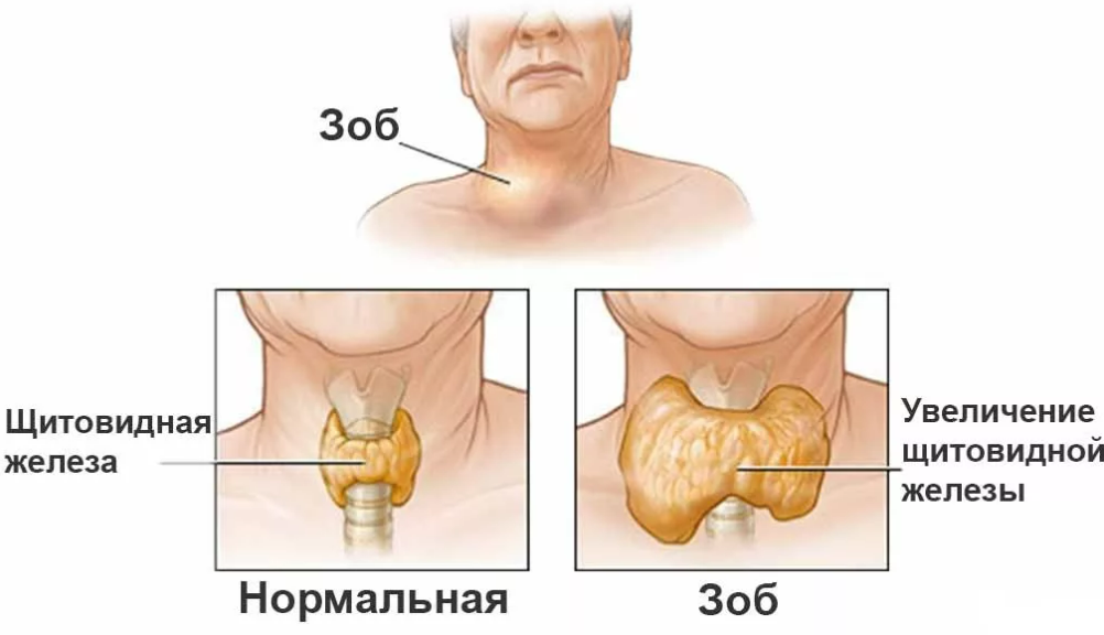 Зоб пищевода. Болезни щитовидной железы. Нормальная и увеличенная щитовидная железа.