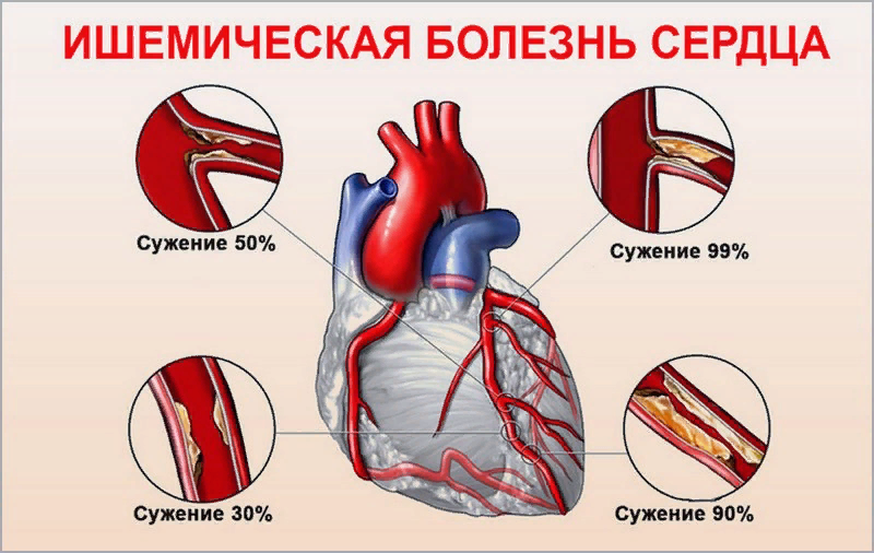 ИШЕМИЧЕСКАЯ БОЛЕЗНЬ СЕРДЦА.