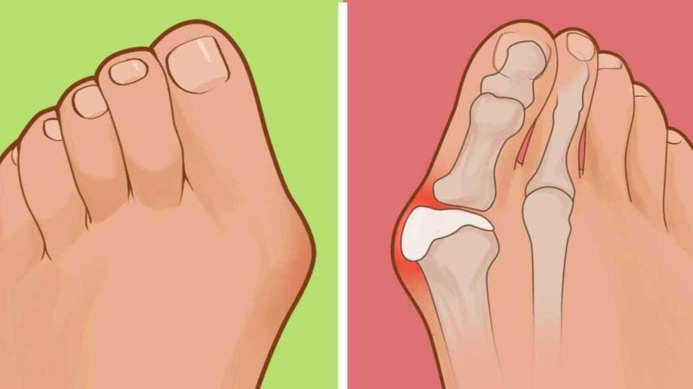 Косточка это вальгусное плоскостопие. Степени вальгусной деформации 1 пальца. Почему нога уходит в сторону. Вальгусная деформация мизинца стопы. Вальгусная деформация косточки.