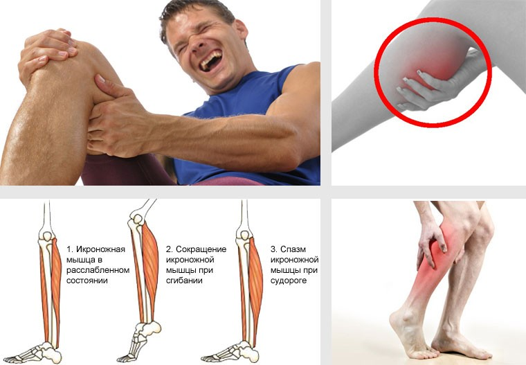 Судороги в ногах икроножные мышцы. Свело икроножную мышцу. Спазмируются икроножные мышцы.