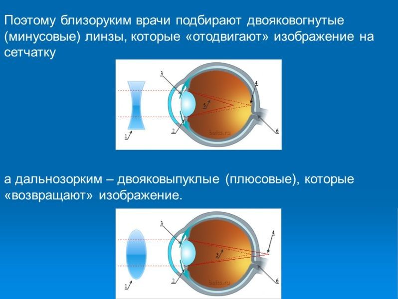 Близоруким людям необходимо использовать очки так как у них изображение фокусируется