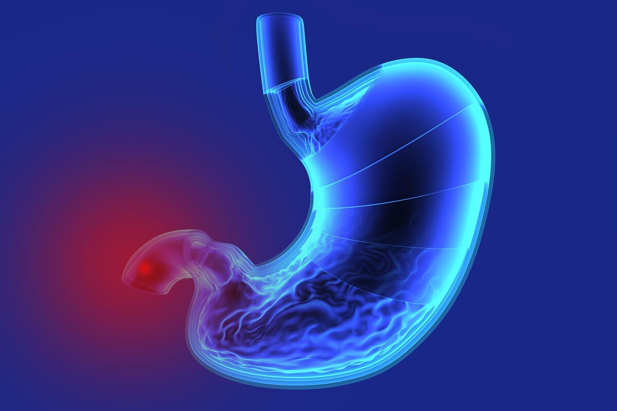 Фото.Питание при язве двенадцатиперстной кишки 