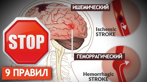 Пресечь правило. Останови инсульт. Инсульт блог Виталия Шабанова.