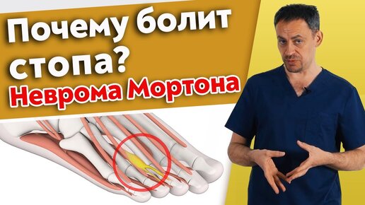 Как вылечить боль в стопе? Что такое неврома Мортона?