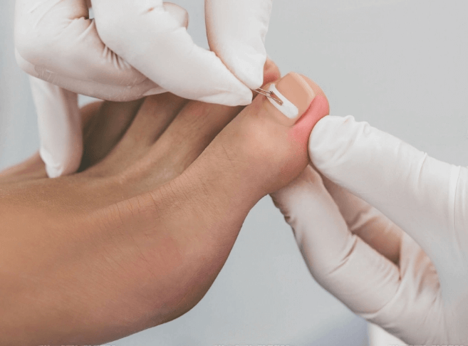 Лечение вросшего ногтя