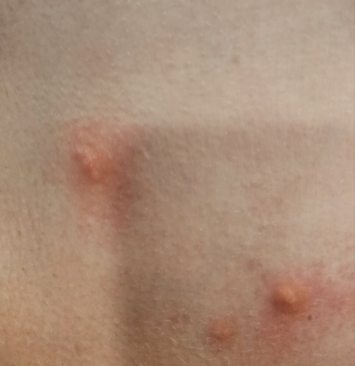 Следы укусов