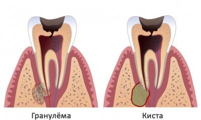 Гранулема зуба: лечение и профилактика