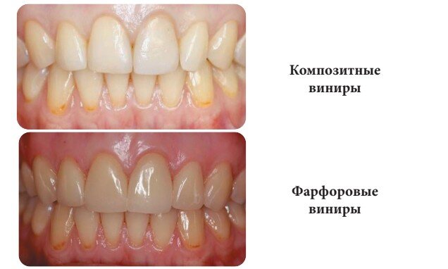 Пациенту была проведена замена изменивших цвет и потерявших блеск прямых композитных виниров на керамические, которые сохраняют свой первоначальный цвет все время пользования