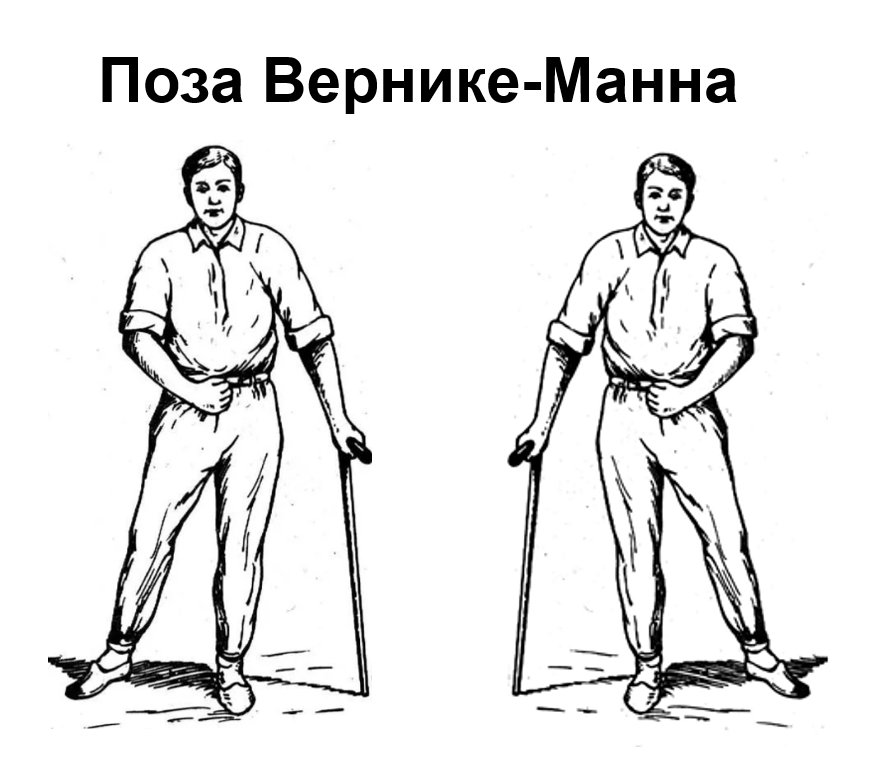 Гемиплегия вернике — манна. Походка вернике манна. Гемиплегия вернике — манна. Контрактура типа вернике — манна. Поза вернике манна.