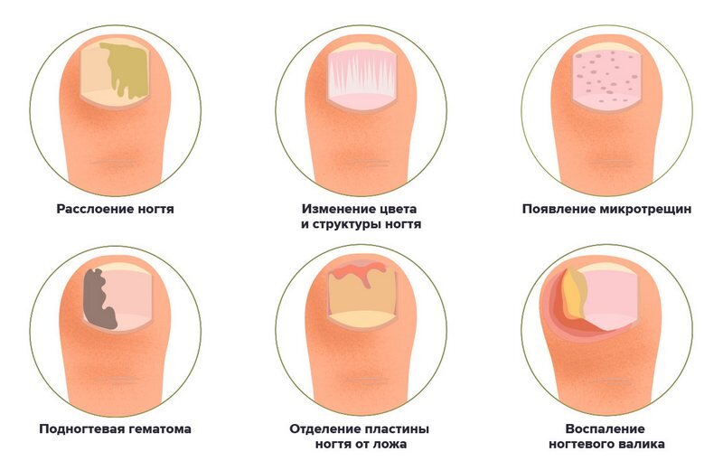 Ожог ногтевой пластины от гель-лака