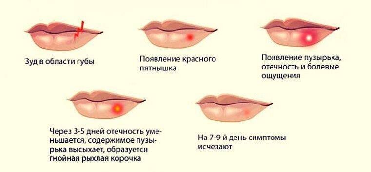 Появились сперва. Стадии появления герпеса.