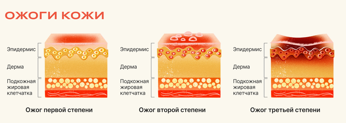 4.3.10. Оказание помощи при ожогах