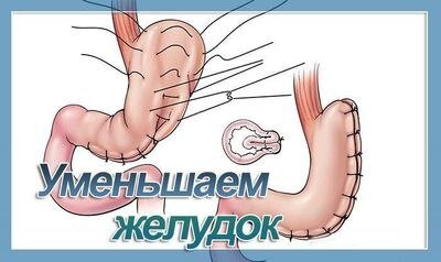 Большой объём желудка доставляет множество неприятностей и портит внешний вид тела. Не нужно расстраиваться и вешать голову. Не нужно спешить к врачу и делать операцию!!!