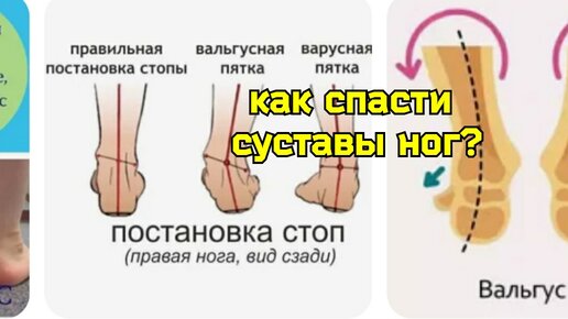 Исправляя вальгус и варус, мы укрепляем стопы и тазобедренные суставы ...