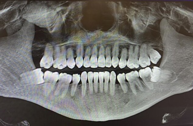 Зубы мудрости таранят корни соседних 7-к