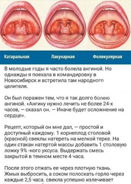 Чем полоскать горло при ангине и как лечить тонзиллит - Здравица