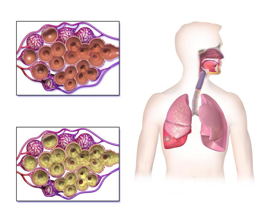 Pneumonia. Пневмония. Воспаление альвеол легких.