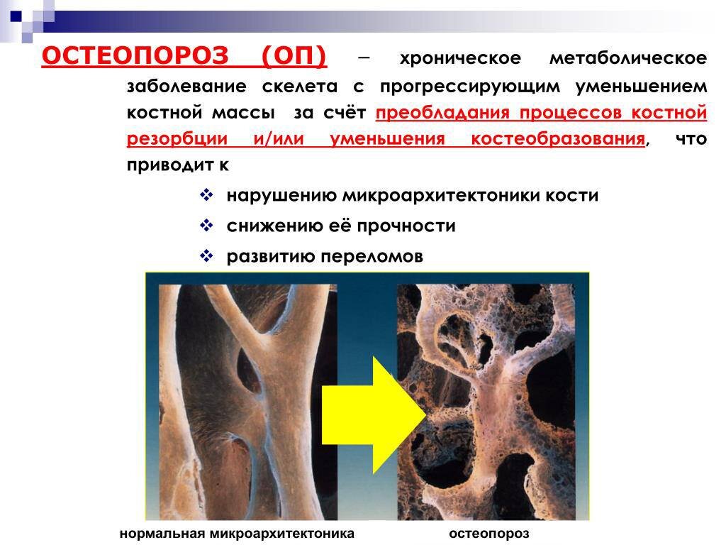 Болезнь костей. Болезнь костей остеопороз. Презентация на тему остеопороз. Остеопороз это хроническое заболевание. Прогрессирующий остеопороз.