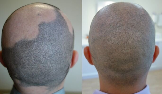 Очень круто! Маскировка очаговой алопеции. У мастера - золотые руки)
