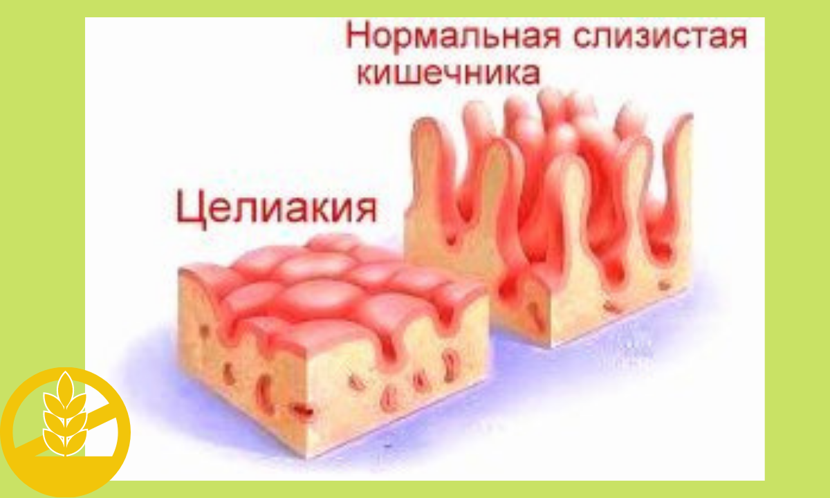 Целиакия учебное пособие. Целиакия макроскопически. Целиакия клинические проявления. Ворсинки кишечника при целиакии.