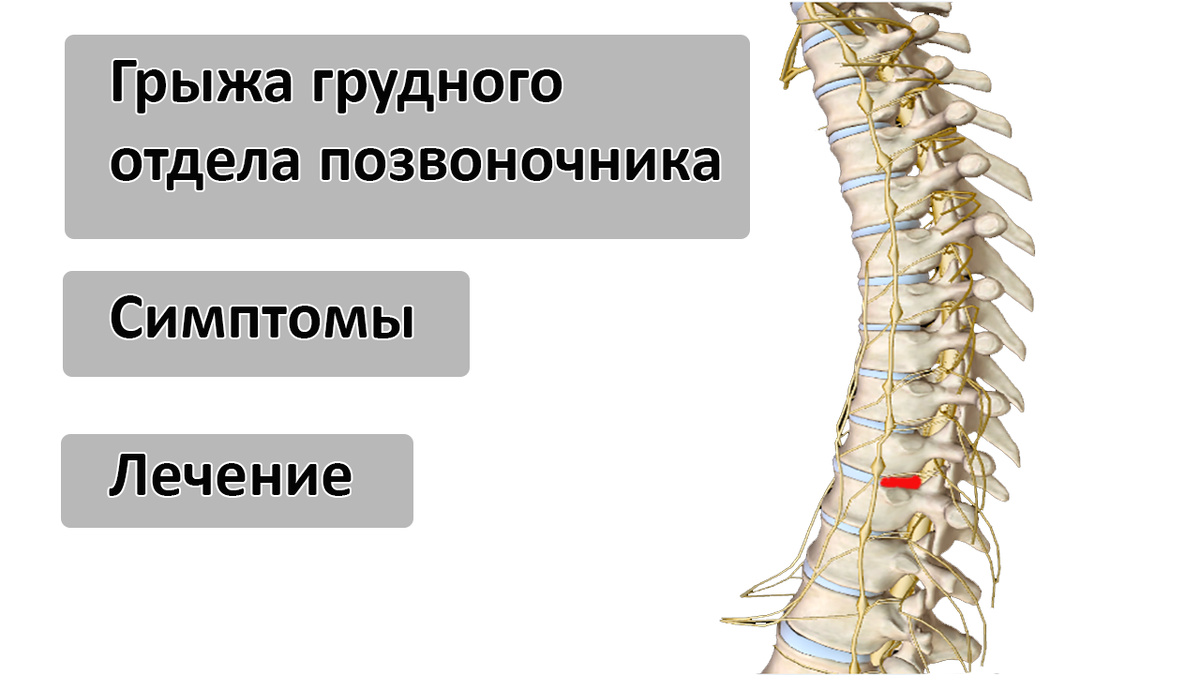 Межпозвоночная грыжа грудного отдела. Что такое Межпозвоночная грыжа грудного отдела?