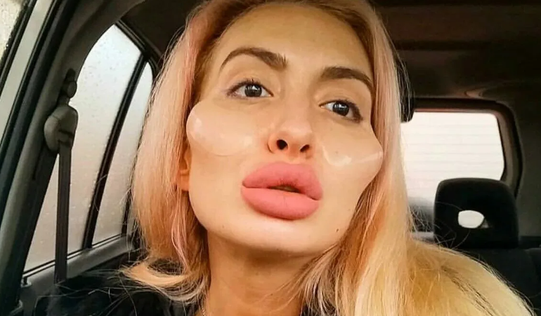 Новые тренды в пластике! От носа Барби, до утиных губ и скул. Красота и привлека