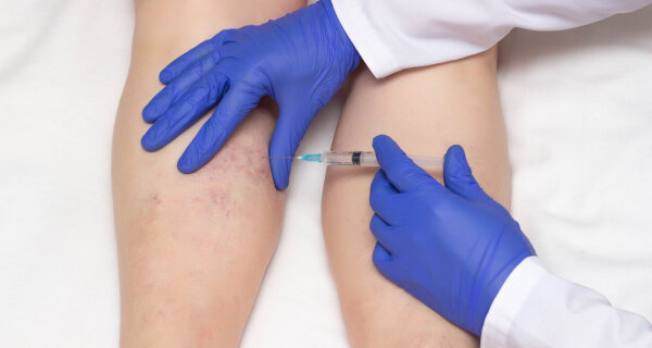 Источник - https://vascul.ru/articles/foot-sclerotherapy