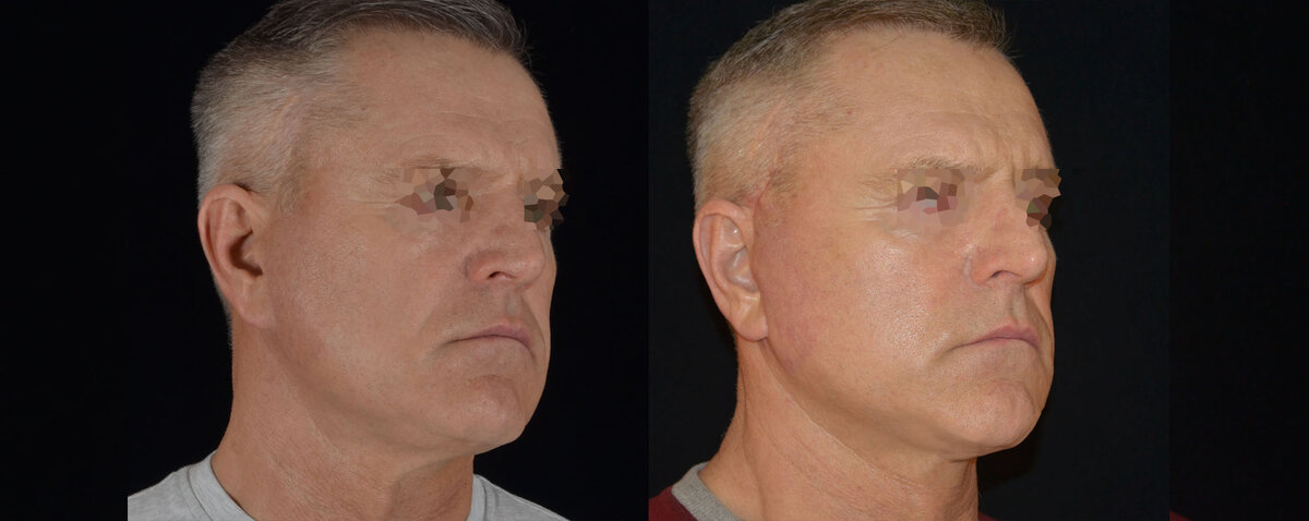 Пластика лица. Фото с сайта Д.Р. Гришкяна. Имеются противопоказания, требуется консультация специалистов