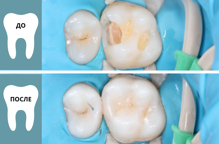 Зуб до установки пломбы и после лечения