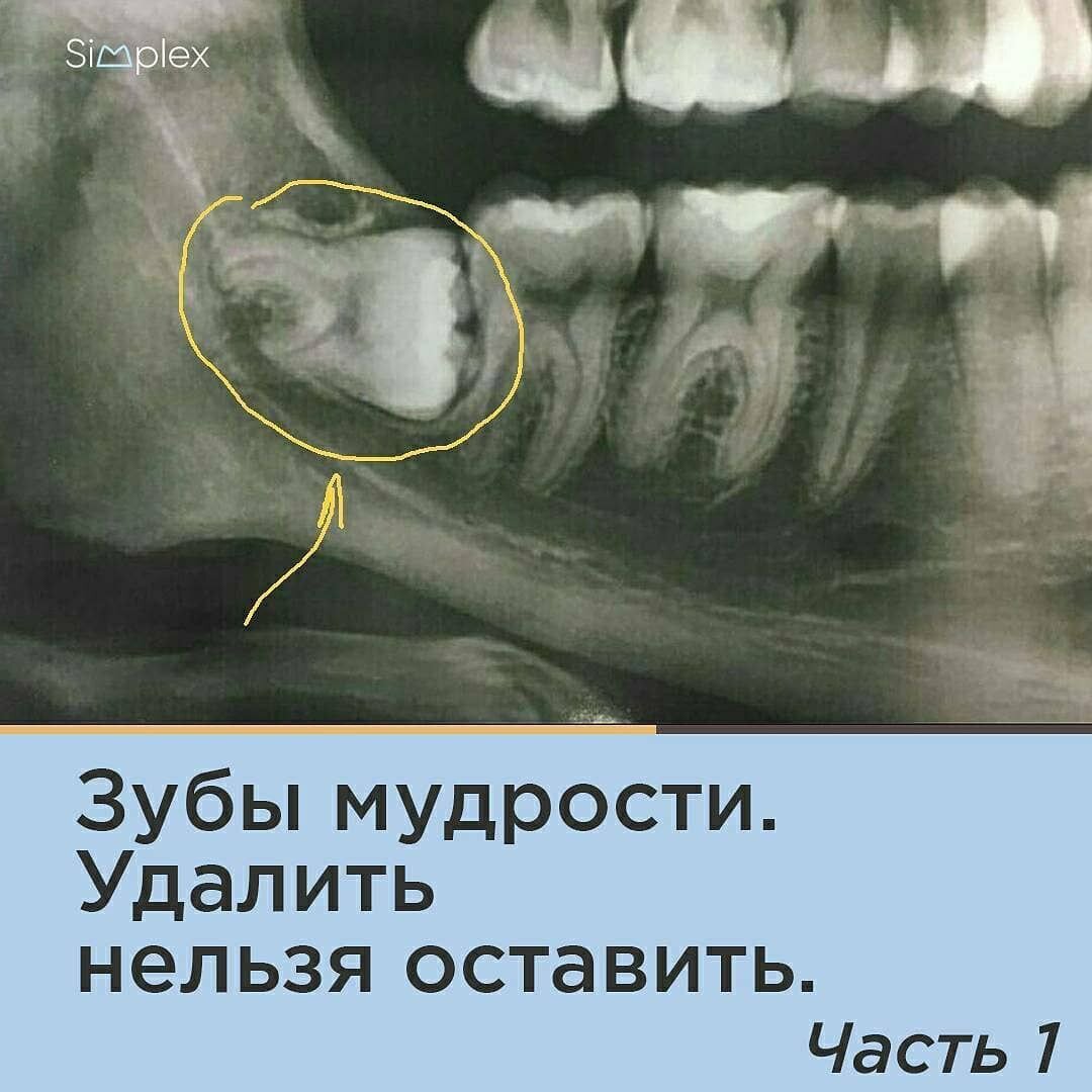 Зубы мудрости: «УДАЛИТЬ НЕЛЬЗЯ ОСТАВИТЬ». Часть 1. | Неочередной стоматолог  | Дзен