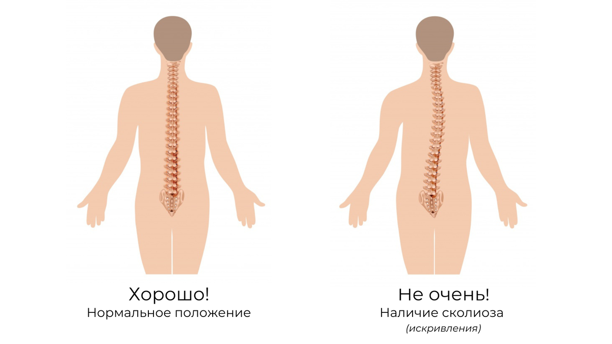 Массаж при сколиозе | Добромед