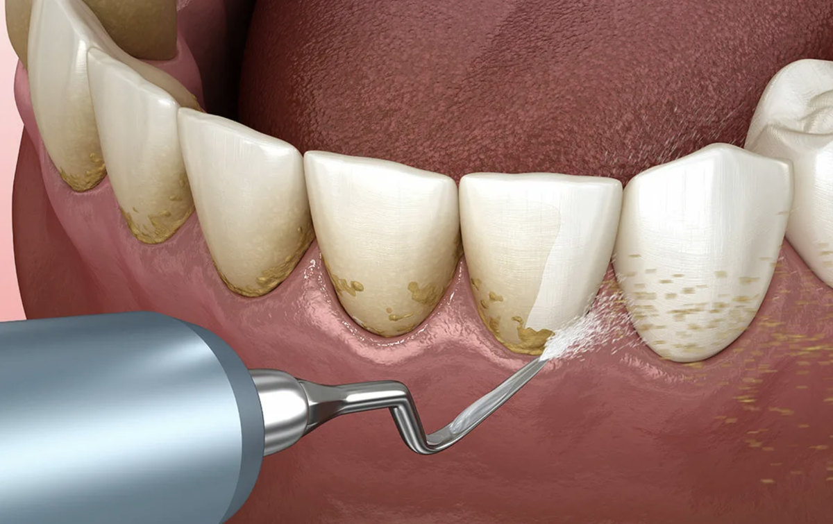 Избавление от зубного камня в домашних условиях